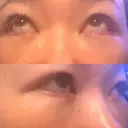 クマ治療 / 下まぶたの脂肪取り / ヒアルロン酸注入（目の下） ROOTS Clinic DAY 4 サムネイル用