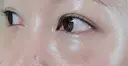 クマ治療 / 下まぶたたるみ取り 湘南美容クリニック 千葉センシティ院 DAY 17 サムネイル用