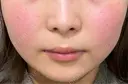 目尻切開 / タレ目形成・グラマラスライン（埋没） / ボトックス（エラ・小顔） LOUIS CLINIC 二子玉川院【ルイクリニック】 DAY 3 サムネイル用