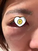 クマ治療 / 豊胸（脂肪注入） / 脂肪注入（目の下） R Beauty CLINIC 銀座院 DAY 0 サムネイル用