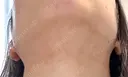 RF（高周波）たるみ治療 大美会クリニック 心斎橋本院 DAY 1 サムネイル用