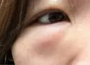 その他（目元） / クマ治療 / 下まぶたの脂肪取り / ヒアルロン酸注入（唇） / ヒアルロン酸注入（目の下） ROOTS Clinic DAY 1 サムネイル用