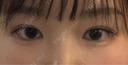 目頭切開 / 自然癒着法 / 眼瞼下垂（非切開） LUHO（ルホ）美容外科 AFTER サムネイル用