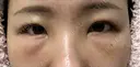 その他（目元） / クマ治療 / 下まぶたの脂肪取り / ヒアルロン酸注入（唇） / ヒアルロン酸注入（目の下） ROOTS Clinic DAY 2 サムネイル用