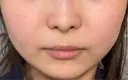 目尻切開 / タレ目形成・グラマラスライン（埋没） / ボトックス（エラ・小顔） LOUIS CLINIC 二子玉川院【ルイクリニック】 DAY 4 サムネイル用