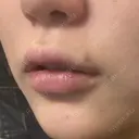 ヒアルロン酸注入（唇） / ボトックス（口角） ルラ美容クリニック 大阪心斎橋院 DAY 3 サムネイル用