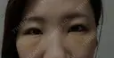 その他（目元） / クマ治療 / 下まぶたの脂肪取り / ヒアルロン酸注入（唇） / ヒアルロン酸注入（目の下） ROOTS Clinic DAY 3 サムネイル用
