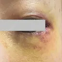 クマ治療 / ボトックス（眉間） / ボトックス（目尻） / ボトックス（額） TCB東京中央美容外科 船橋院 DAY 5 サムネイル用