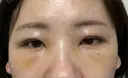 その他（目元） / クマ治療 / 下まぶたの脂肪取り / ヒアルロン酸注入（唇） / ヒアルロン酸注入（目の下） ROOTS Clinic DAY 4 サムネイル用