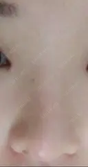 鼻尖形成（切開） / 鼻中隔延長（切開） / 小鼻縮小（切開） / 軟骨移植 / 骨切幅寄せ / 鼻尖縮小 HANABI整形外科 DAY 51 サムネイル用