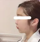 脂肪注入（輪郭） / 再生医療 / PRP皮膚再生療法 チョンダムオラクル皮膚科整形外科医院 DAY 7 サムネイル用