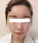 脂肪注入（輪郭） / 再生医療 / PRP皮膚再生療法 チョンダムオラクル皮膚科整形外科医院 DAY 7 サムネイル用