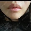 ボトックス（あご） / ボトックス（エラ・小顔） / ヒアルロン酸注入（唇） / ボトックス（眉間） / ボトックス（人中） 上野美容外科・美容皮膚科 AFTER サムネイル用