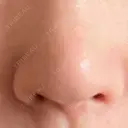 鼻尖形成（切開） / 軟骨移植 / 鼻孔縁下降 / 鼻柱下降・鼻唇角形成（猫手術） もとび美容外科クリニック 新宿院 DAY 17 サムネイル用