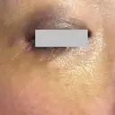 クマ治療 / ボトックス（眉間） / ボトックス（目尻） / ボトックス（額） TCB東京中央美容外科 船橋院 DAY 6 サムネイル用