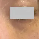 クマ治療 / ボトックス（眉間） / ボトックス（目尻） / ボトックス（額） TCB東京中央美容外科 船橋院 DAY 6 サムネイル用