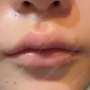 ヒアルロン酸注入（唇） / ボトックス（口角） ルラ美容クリニック 大阪心斎橋院 AFTER サムネイル用