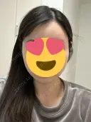 額を丸く / 脂肪吸引（二の腕） / こめかみ形成 / 脂肪注入（額） / 脂肪吸引（肩） / 脂肪注入（輪郭） Mods Clinic（モッズクリニック） 名古屋院 DAY 183 サムネイル用