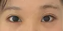 目尻切開 / タレ目形成・グラマラスライン（埋没） LOUIS CLINIC 二子玉川院【ルイクリニック】 AFTER サムネイル用