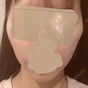 糸リフト / 肌ヒアルロン酸注入（たるみ・シワ改善） 上野美容外科・美容皮膚科 DAY 2 サムネイル用