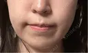 脂肪吸引注射（顔） 東京シンデレラ美容外科 池袋院 DAY 0 サムネイル用