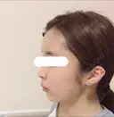 脂肪注入（輪郭） / 再生医療 / PRP皮膚再生療法 チョンダムオラクル皮膚科整形外科医院 DAY 12 サムネイル用