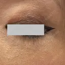 クマ治療 / ボトックス（眉間） / ボトックス（目尻） / ボトックス（額） TCB東京中央美容外科 船橋院 DAY 7 サムネイル用