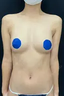 豊胸（脂肪注入） 湘南美容クリニック 吉祥寺院 DAY 92 サムネイル用