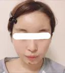 脂肪注入（輪郭） / 再生医療 / PRP皮膚再生療法 チョンダムオラクル皮膚科整形外科医院 DAY 12 サムネイル用