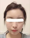 脂肪注入（輪郭） / 再生医療 / PRP皮膚再生療法 チョンダムオラクル皮膚科整形外科医院 DAY 30 サムネイル用