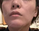 糸リフト / 脂肪吸引（顔） Wing clinic 豊中駅前院 DAY 6 サムネイル用
