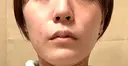 糸リフト / 脂肪吸引（顔） Wing clinic 豊中駅前院 DAY 7 サムネイル用
