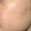 ピーリング（ニキビ・毛穴） 大美会クリニック 梅田院 AFTER サムネイル用