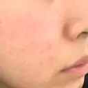 ポテンツァ 上野美容外科・美容皮膚科 AFTER サムネイル用