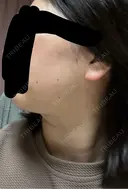 RF（高周波）たるみ治療 大美会クリニック 心斎橋本院 DAY 6 サムネイル用