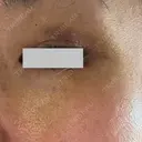 クマ治療 / ボトックス（眉間） / ボトックス（目尻） / ボトックス（額） TCB東京中央美容外科 船橋院 DAY 8 サムネイル用