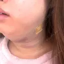 脂肪吸引（顔） TCB東京中央美容外科 新横浜院 DAY 1 サムネイル用