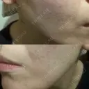ハイフ（顔） 東京美容外科 名古屋院 AFTER サムネイル用