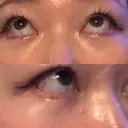 クマ治療 / 下まぶたの脂肪取り / ヒアルロン酸注入（目の下） ROOTS Clinic AFTER サムネイル用