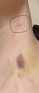 豊胸（脂肪注入） 銀座マイアミ美容外科 DAY 9 サムネイル用