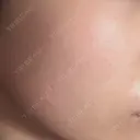 イオン導入 / 毛穴洗浄（ハイドラフェイシャルなど） / 光治療（フォトフェイシャルなど） / その他（鼻） ルラ美容クリニック 札幌本院 AFTER サムネイル用