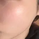 イオン導入 / 毛穴洗浄（ハイドラフェイシャルなど） / 光治療（フォトフェイシャルなど） / その他（鼻） ルラ美容クリニック 札幌本院 DAY 7 サムネイル用