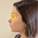 隆鼻術 / 鼻尖形成（切開） / 鼻中隔延長（切開） / 軟骨移植 / 鼻修正 / 鼻尖縮小 / 真皮移植 / 小鼻縮小（非切開） 銀座マイアミ美容外科 DAY 10 サムネイル用