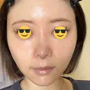 隆鼻術 / 鼻尖形成（切開） / 鼻中隔延長（切開） / 軟骨移植 / 鼻修正 / 鼻尖縮小 / 真皮移植 / 小鼻縮小（非切開） 銀座マイアミ美容外科 DAY 10 サムネイル用