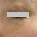 クマ治療 / ボトックス（眉間） / ボトックス（目尻） / ボトックス（額） TCB東京中央美容外科 船橋院 DAY 9 サムネイル用