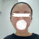 脂肪注入（額） EMMA CLINIC（エマクリニック） DAY 0 サムネイル用