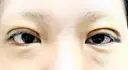 二重埋没 / 上まぶたの脂肪取り / ボトックス（額） 9BeautyClinic DAY 2 サムネイル用