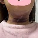 脂肪吸引（顔） TCB東京中央美容外科 新横浜院 DAY 2 サムネイル用