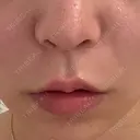 人中短縮 / ボトックス（人中） eクリニック 金沢本院 AFTER サムネイル用