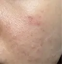 ピコレーザートーニング（美白・かんぱん） / ピコフラクショナルレーザー（毛穴・ニキビ跡） サクラアズクリニック 心斎橋院 DAY 2 サムネイル用